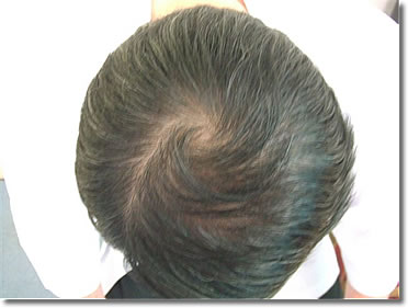 「頭髪実験」2006年6月-2
