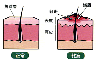 尋常性乾癬　イラスト