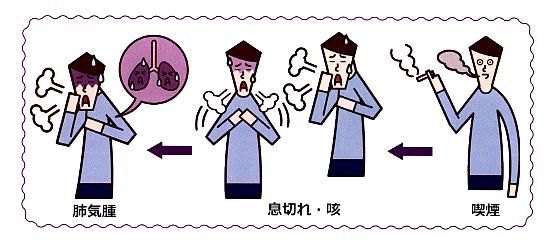 肺気腫イラスト