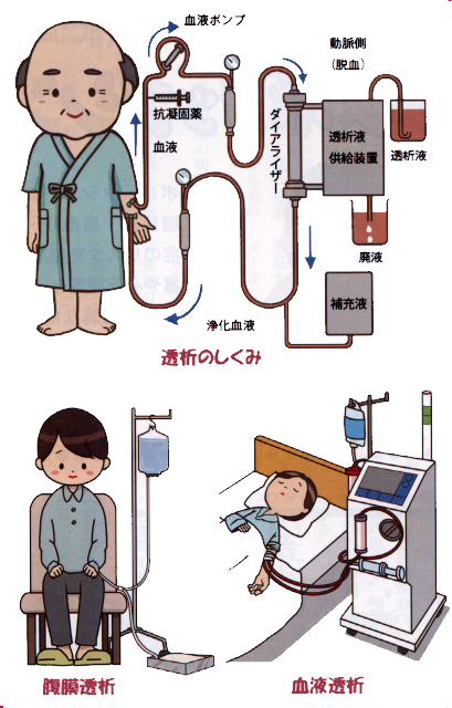 糖尿病と透析療法イラスト