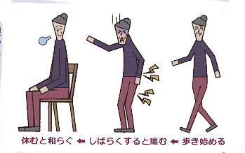 腰部脊柱管狭窄症イラスト