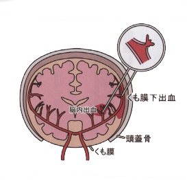 くも膜下出血　イラスト