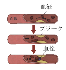 動脈硬化