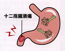 十二指腸潰瘍
イラスト