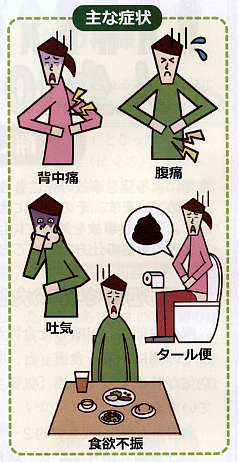 十二指腸潰瘍
 イラスト