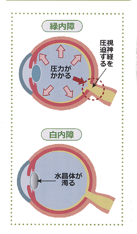 緑内障と白内障　イラスト