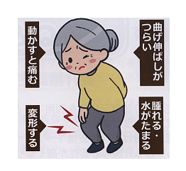 変形性膝関節症イメージイラスト